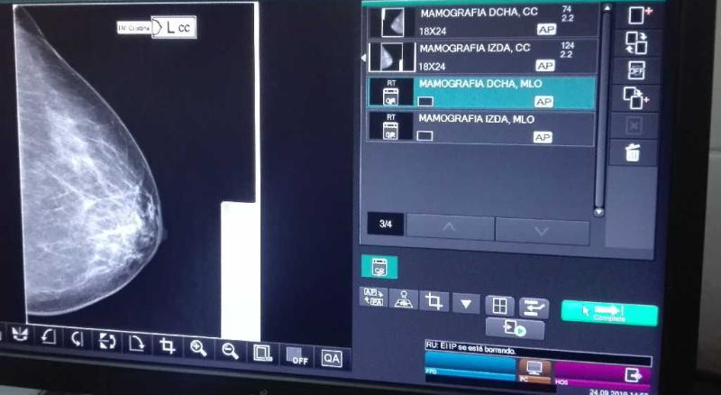 La mamografía digital permite detectar lesiones pequeñas no palpables por la paciente ni el facultativo. Foto: Arelys García