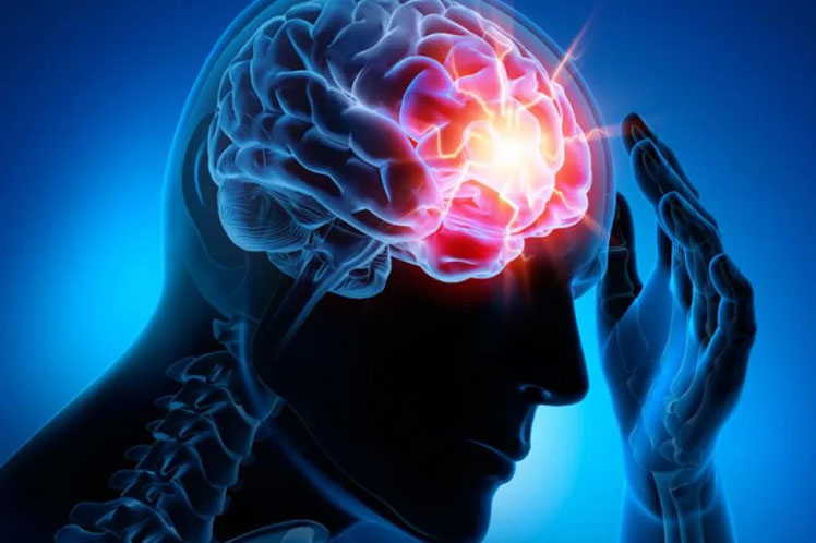 cuba, cigb, enfermedades cerebrovasculares, neurologia, infarto cerebral