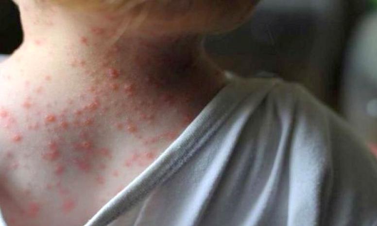 oms, salud, viruela del mono, virus